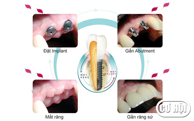 Implant - Phương pháp hiện đại điều trị mất răng